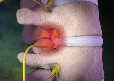 Chiropraxie & Motifs de Consultations vertebre nerf pincé